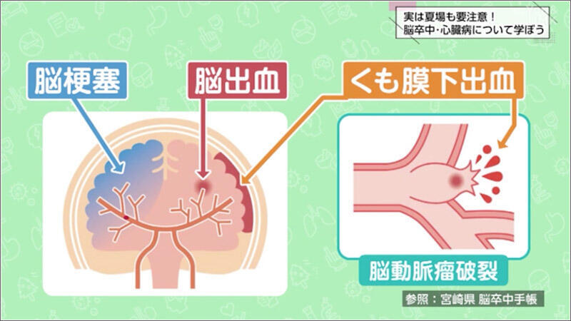 01 脳卒中とは