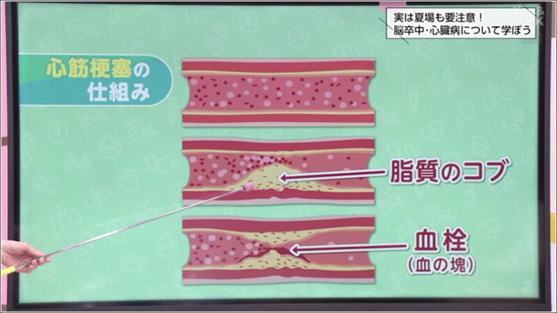 04 心筋梗塞の仕組み