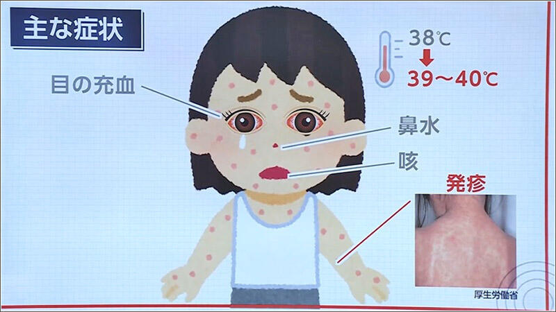 04 はしかの初期症状
