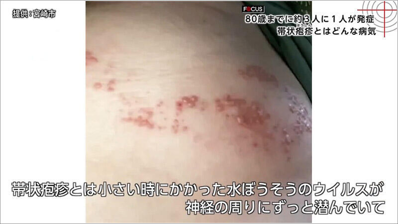 01 帯状疱疹
