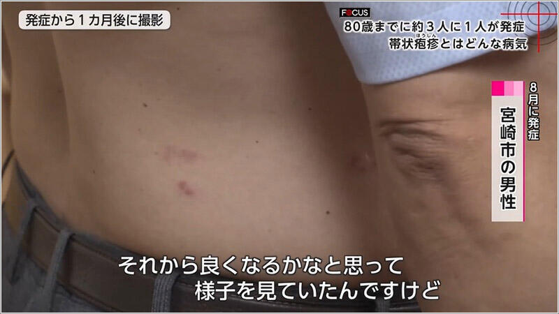03 8月に発症した男性 1
