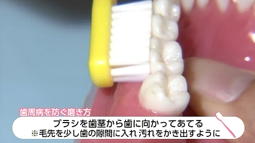 写真：歯周病を防ぐ磨き方
