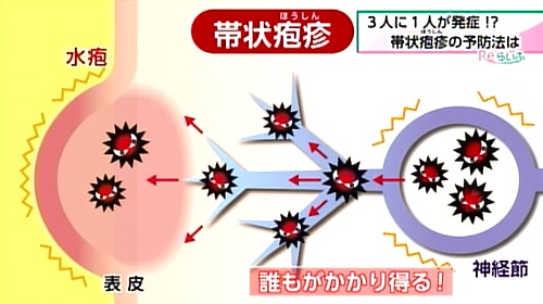 帯状疱疹発祥のしくみ