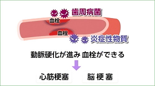 歯周病による弊害