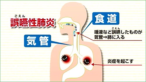 誤嚥性肺炎をひき起こす恐れ