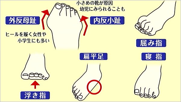 身だしなみ改善術 正しい姿勢は足から 18年6月21日放送 Reらいふ Umkスーパーニュース Umkテレビ宮崎